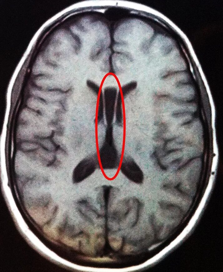 Аномалии развития желудочков головного мозга. Мрт желудочков головного мозга в норме. Аномалии боковых желудочков мрт головного мозга. Желудочки головного мозга кт анатомия.
