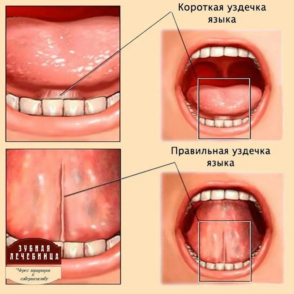 Родиться без языка. Укороченная подъязычная уздечка.