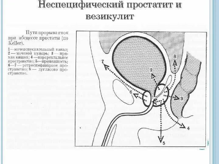 Везикулит симптомы и лечение у мужчин. Что такое везикулит предстательной железы. Хронический везикулит предстательной железы. Везикулостаз предстательной железы что это.