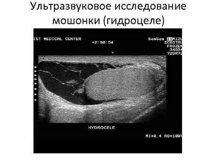 Что такое водянка яичка у мужчин