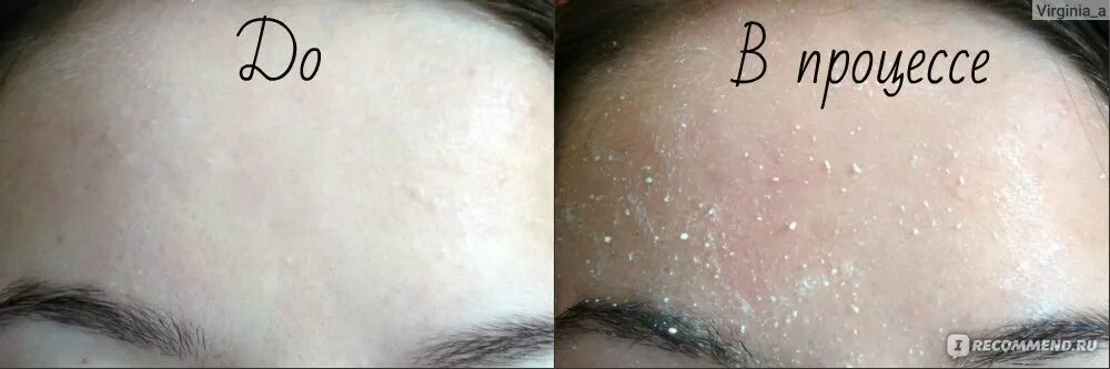 Скатка для лица кальций хлорид. Пилинг кальция хлорид. Хлористый кальций пилинг для лица. Пилинг хлористым кальцием. Скатка для лица с хлористым кальцием.