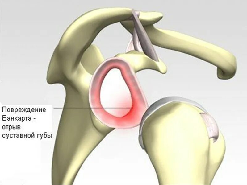 Хилл Сакса плечевого сустава. Банкарта плечевого сустава. Суставная губа плечевого сустава разрыв. Банкарт плечевой сустав.