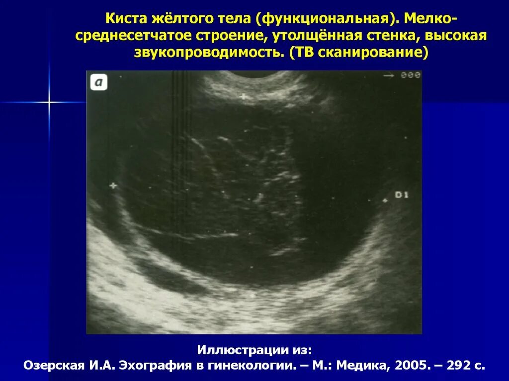 Функциональная киста желтого тела. Регрессирующая киста желтого тела.