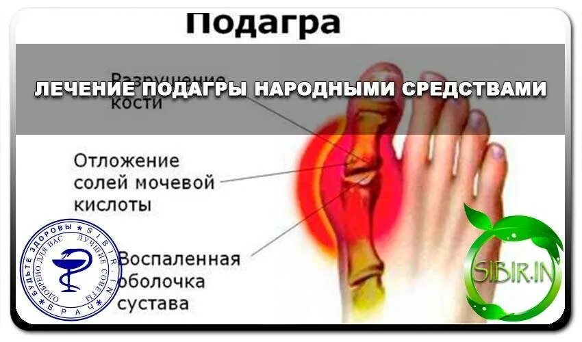 Подагра диета. Подагровый артрит диета. Схема терапии подагры. Подагра симптоматическая терапия. Подагра признаки и лечение народное.