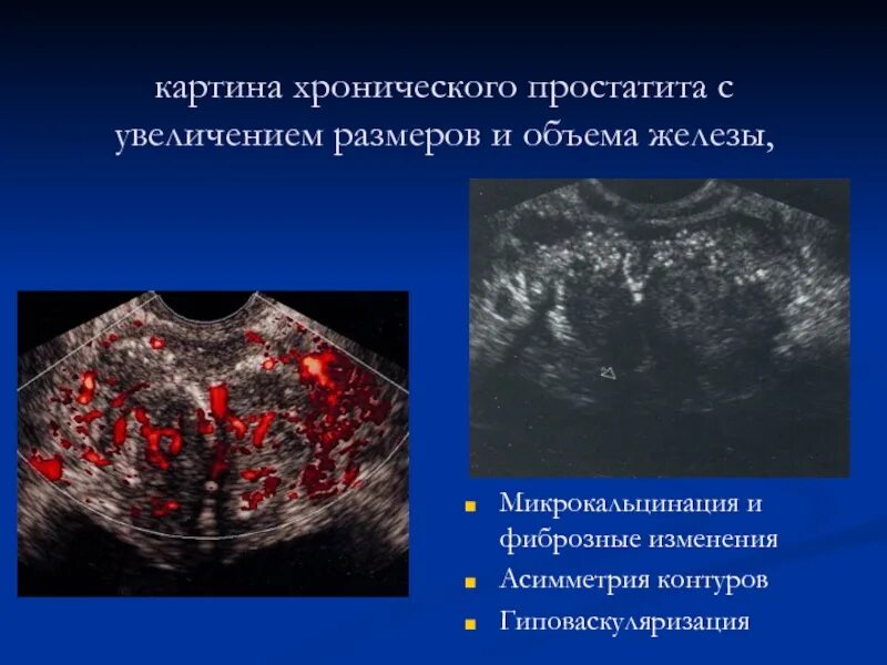 Фиброзные изменения предстательной железы