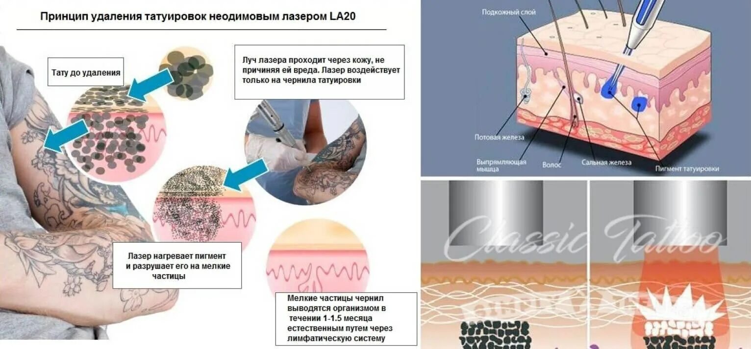Эффективные способы удаления. Процесс нанесения Татуировки схема. Лазерное удаление тату. Принцип работы лазерного удаления Татуировки. Воздействие неодимового лазера на кожу.