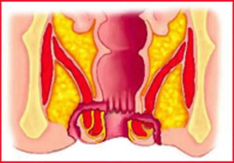 Сильно болит задний проход. Острый пельвиоректальный парапроктит. Парапроктит параректальные свищи. Хронический парапроктит.