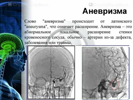 Что такое аневризма головного мозга простыми словами