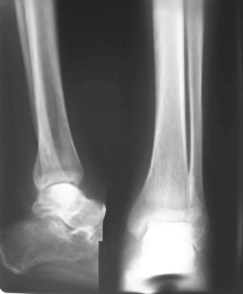 асептический некроз мыщелка коленного сустава. аваскулярный некроз медиального мыщелка бедренной кости. остеонекроз коленного сустава рентген. асептический некроз мыщелка. остеонекроз медиального мыщелка мрт.