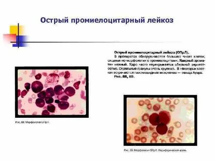 Лейкозы клинические рекомендации