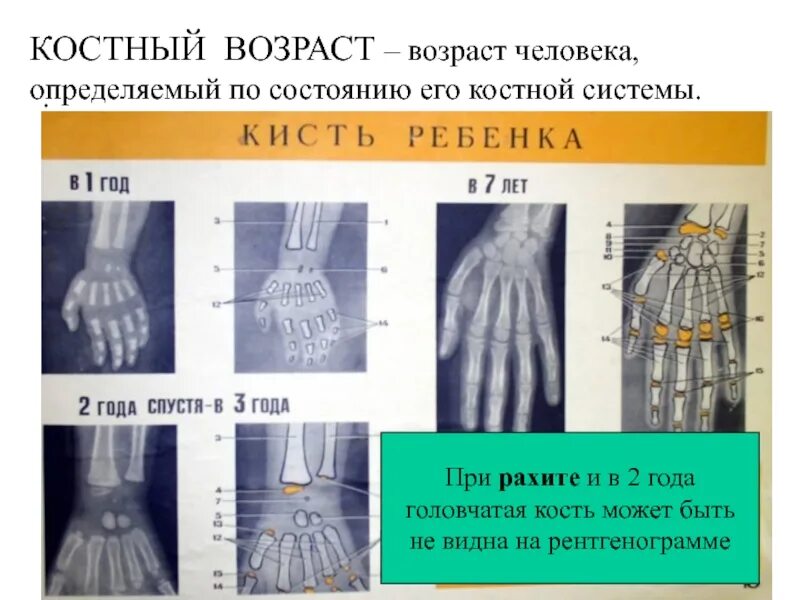 Костный как проверить. Костный возраст рентгенограмма кисти рук. костный возраст рентген кисти. костный возраст таблица рентген кистей. костный возраст по рентгенограмме кисти 7 лет.