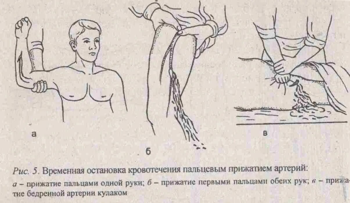 Пальцевое прижатие сосудов бедренная артерия. Пальцевое прижатие подколенной артерии. Точки измерения артериального пульса брюшной аорты. Пальцевое прижатие артерий подколенной артерии.