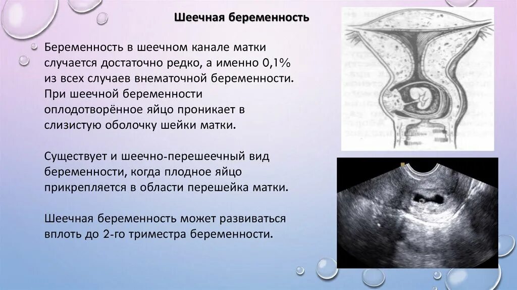 Матка в каком месте. Эктопическая шеечная беременность. Внематочная беременность. При внематочной беременности. Формы внематочной беременности.