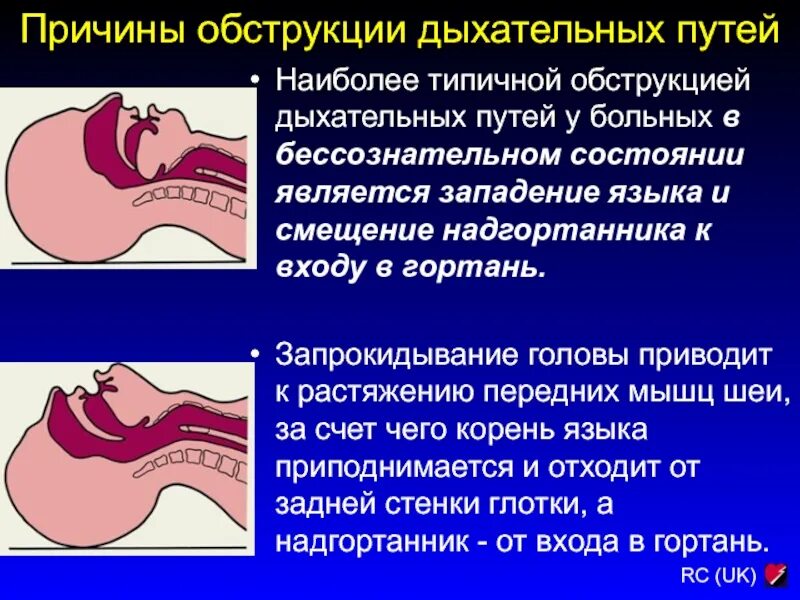 Западание языка помощь