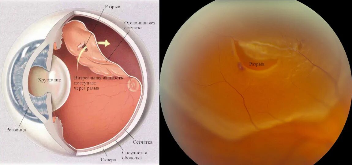Воронкообразная отслойка сетчатки. Тракционная отслойка сетчатки глаза. Регматогенная отслойка сетчатки глаза. Глазное дно отслоение сетчатки.