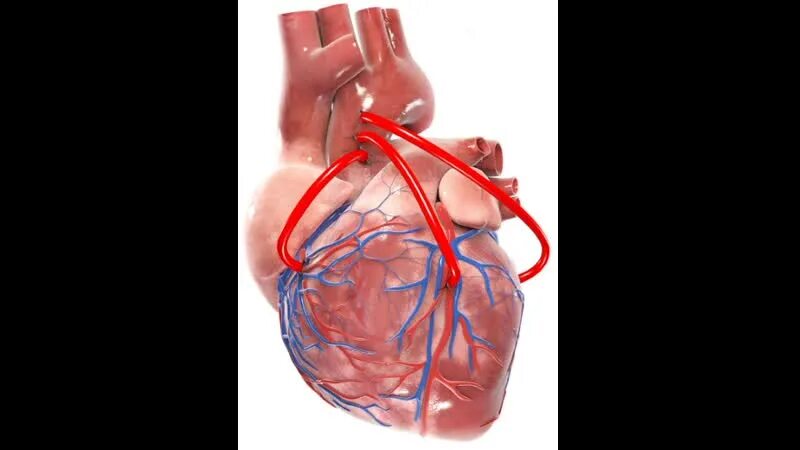 Аортокоронарное шунтирование (АКШ). Операция шунтирование сосудов сердца. Двухсосудистое коронарное шунтирование. Шунтирование артерий сердца.