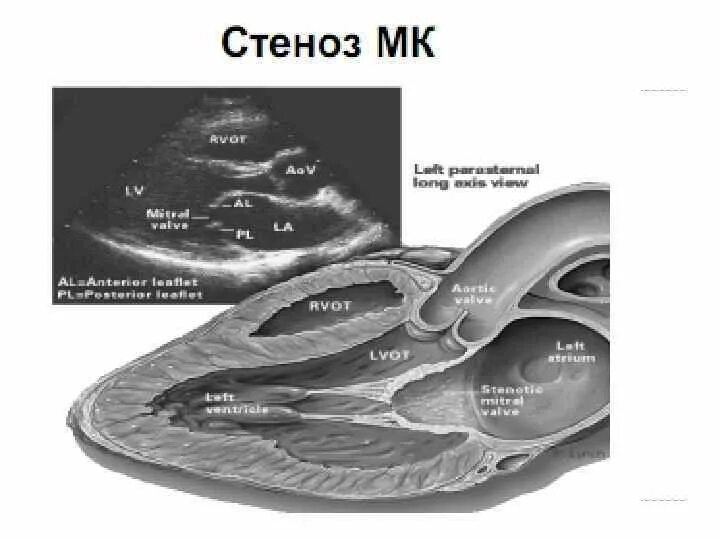 Миксоматозная дегенерация митрального клапана ЭХОКГ. Миксоматозные изменения створок. Итральный.