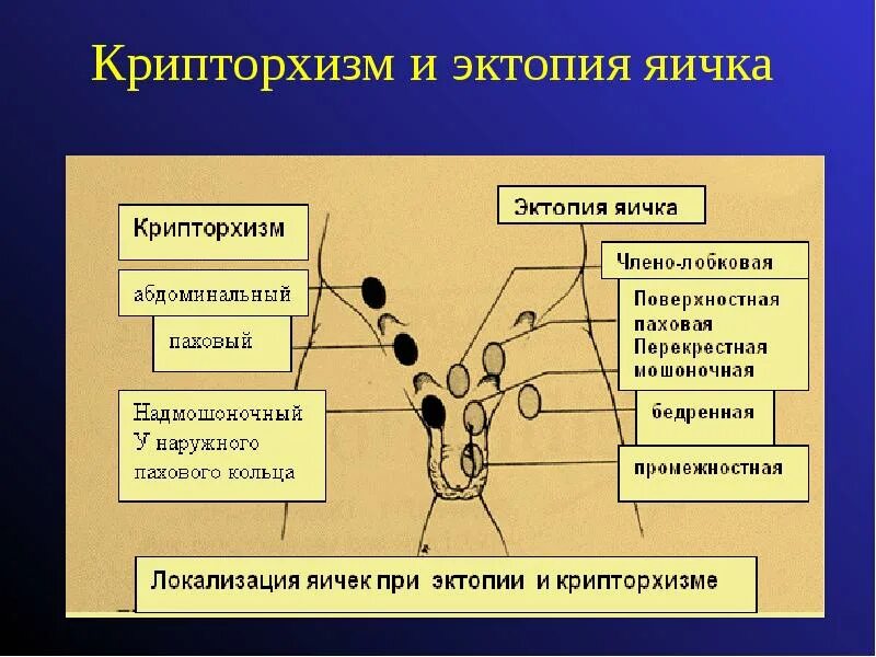 Крипторхизм классификация. Классификация крипторхизма у детей. Расположение яичка при крипторхизме. Ложный крипторхизм