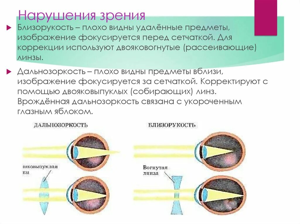 У близоруких людей изображение фокусируется перед сетчаткой. Двояковогнутая линза для близорукости. Нарушение зрения презентация. Двояковогнутая линза для дальнозоркости. Близорукость перед сетч.