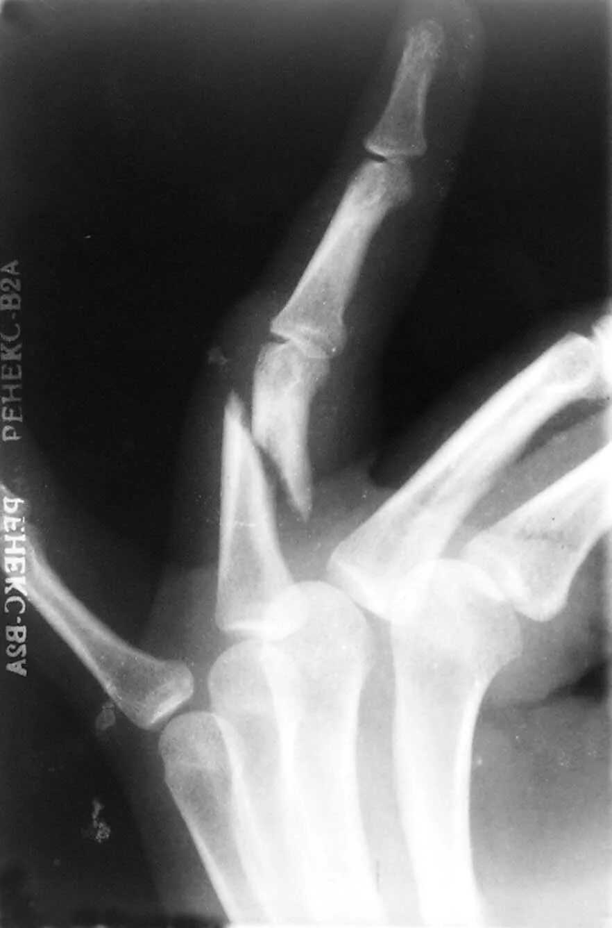 сломанная фаланга. сломанная фаланга. краевой оскольчатый перелом пальца руки. оскольчатый перелом основной фаланги 1 пальца. внутрисуставной перелом ногтевой фаланги.