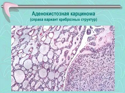 Опухоли слюнных желез у детей по утвержденным