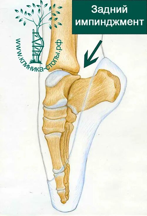 Синдромы голеностопного сустава. Импиджмент синдром голеностопного сустава рентген. Импинджмент синдром в голеностопе. Латеральный импинджмент синдром голеностопного сустава. Импиджмент синдром голеностопа мрт.