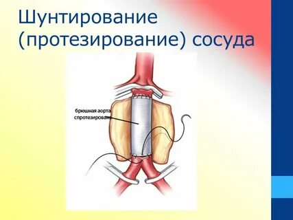 Шунтирование артерий