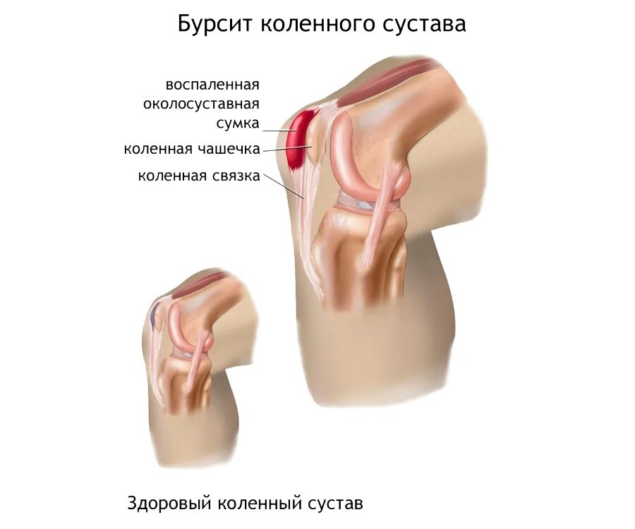 Бурсит коленного сустава — воспаление синовиальной сумки колена;. Методы лечения бурсита. Бурсит локтевого сустава. Подагрический бурсит локтевого сустава. Супрапателлярный бурсит гнойный.