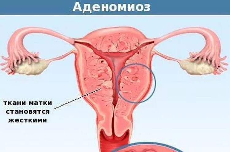 При аденомиозе можно забеременеть. Фибромиома матки с аденомиозом. Аденомиоз и эндометриоз. Миома матки в сочетании с аденомиозом что это такое.