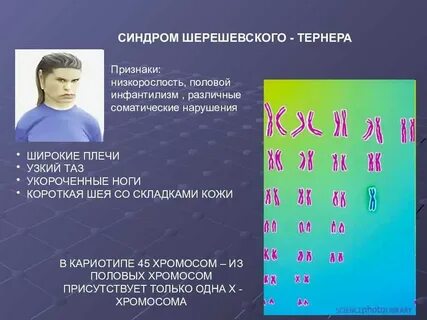 Кариотип больной шерешевского тернера