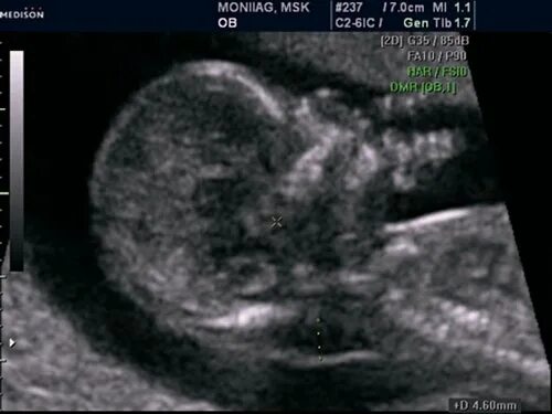 Ксс у плода. ТВП 12 недель синдром Дауна. УЗИ плода с синдромом Дауна в 20 недель беременности. УЗИ эмбриона с синдромом Дауна. УЗИ плода с синдромом Дауна в 12 недель.