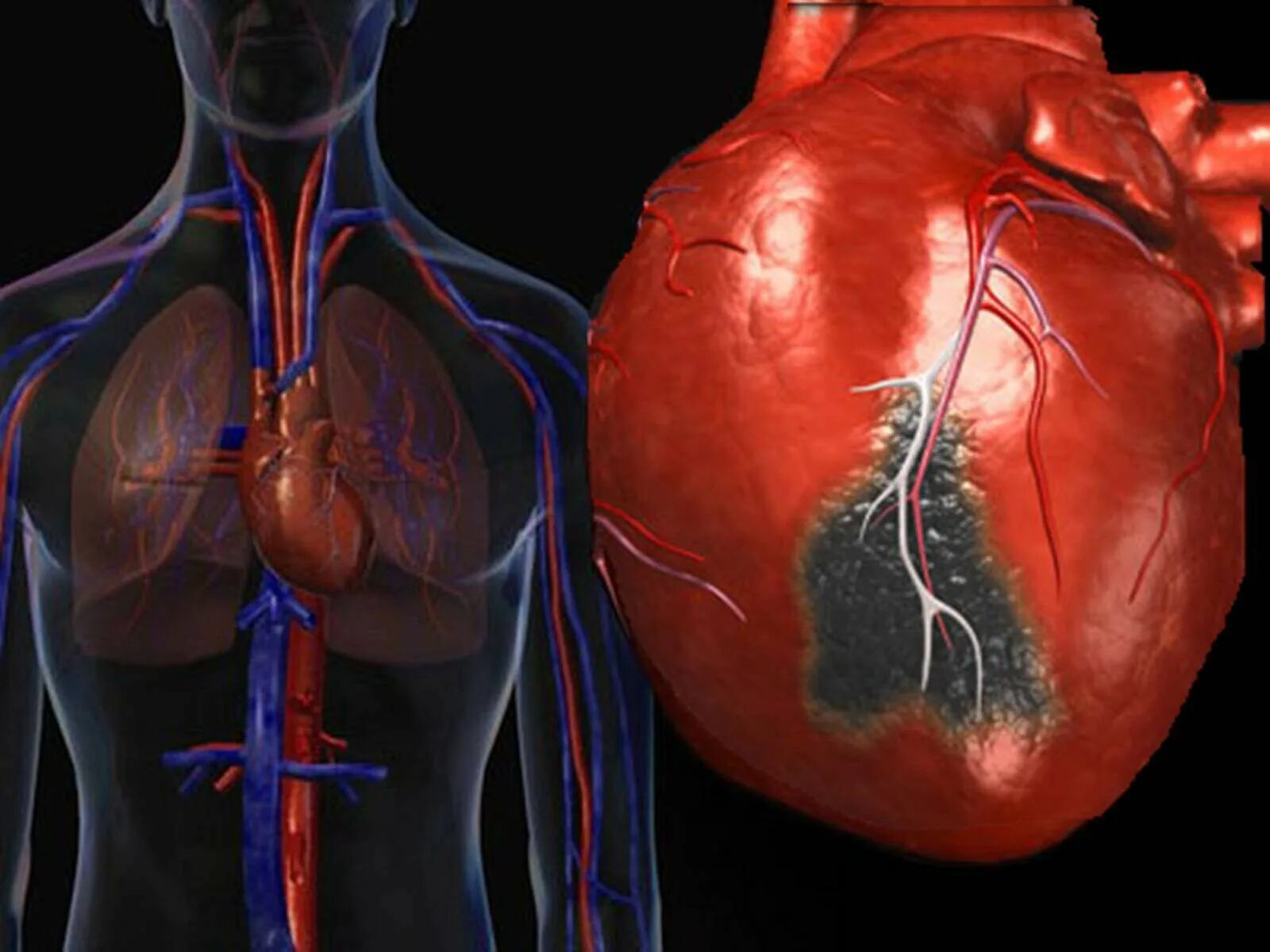 Осложнение на сердце после. Инфаркт миокарда патология. Ишемическая болезнь инфаркт миокарда.