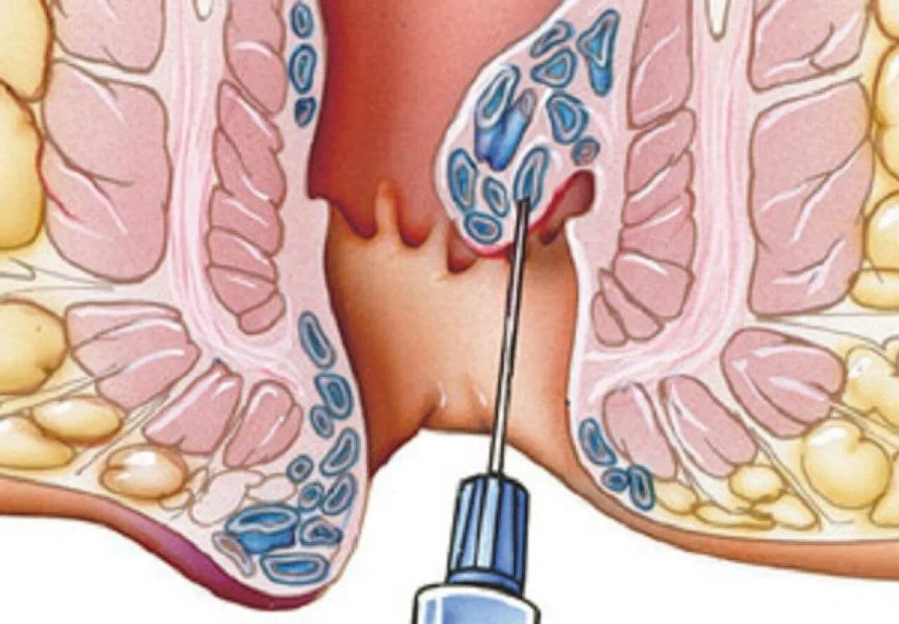Какой врач лечит геморрой. Тромбированный узел геморрой. Внешний геморроидальный узел.