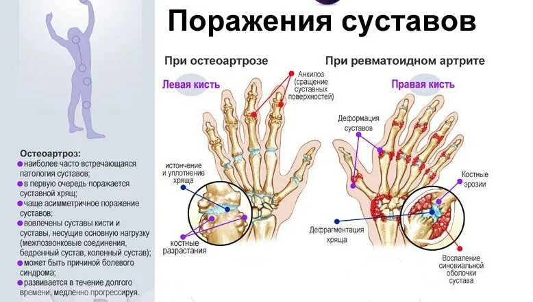 Форма поражения суставов при ревматоидном артрите:. Суставные поражения при ревматоидном артрите. Кисти с ревматоидным артритом бутоньерка. Поражение суставов при ревматомидном артрит. Лечение артрита суставов в домашних условиях