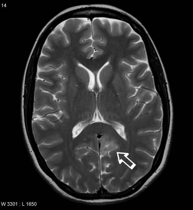 Фокальная корковая дисплазия (фкд). Кортикальная дисплазия кт. Фокальная дисплазия височной доли. Фокальная кортикальная дисплазия мрт. Фокальная корковая дисплазия мрт.