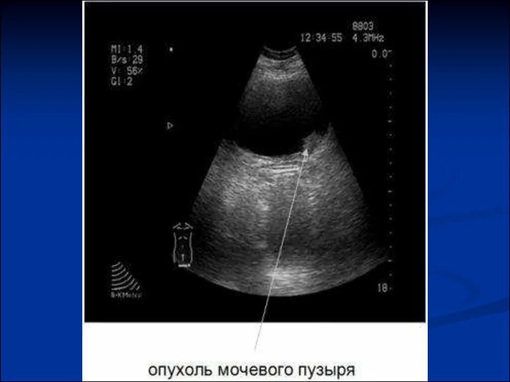 Утолщение мочевого пузыря у мужчин. Ультразвуковое исследование мочевого пузыря трансабдоминальное. Фиброма мочевого пузыря УЗИ. Опухоль мочевого пузыря УЗИ. Образования мочевого пузыря на УЗИ.