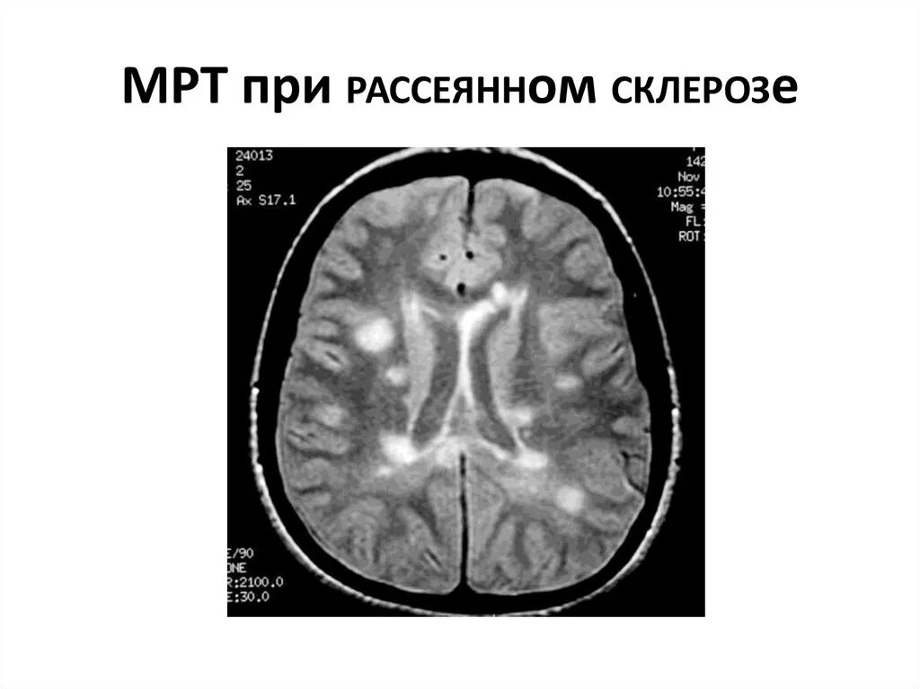 Склероз мозга. Картина рассеянного склероза на мрт. Картина мрт при рассеянном склерозе. Мрт при рассеянном склерозе с контрастом. МР при рассеянном склерозе.