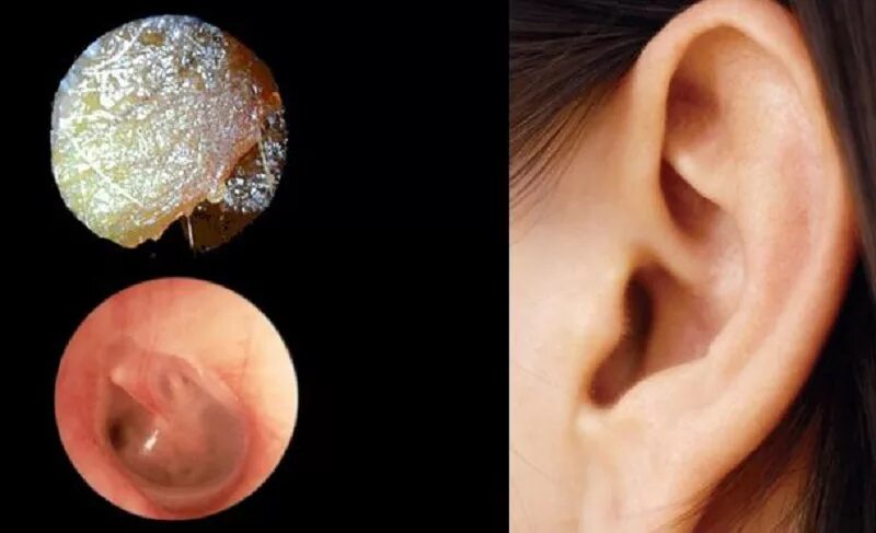 Почему образуются пробки в ушах. Отомикоз серная пробка. Гнойный отит отоскопия.