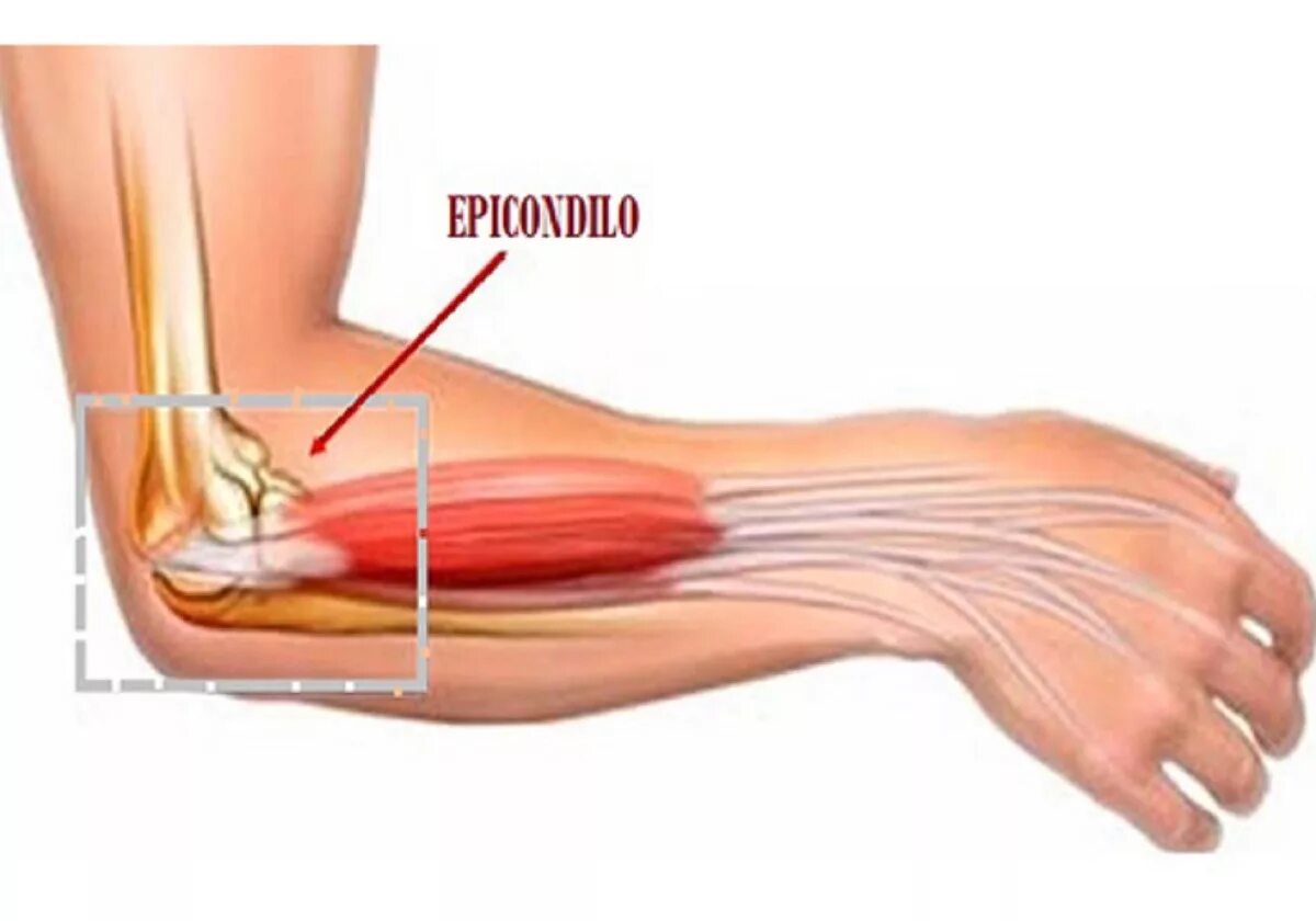 Лечение предплечья. Тендинопатия сухожилия локтевого сустава. Тендинит сухожилия предплечья. Латеральный эпикондилит.