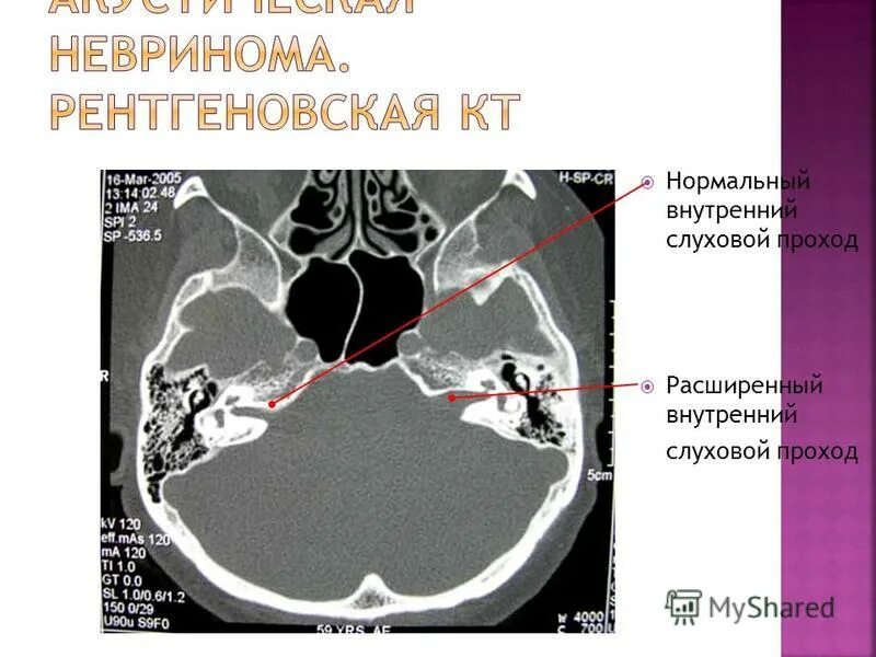 внутренний слуховой проход мрт