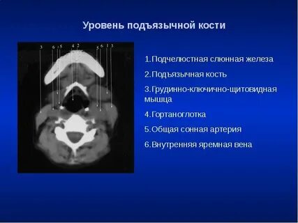Небные миндалины на кт