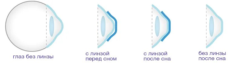 Как можно скорректировать зрение при помощи линз. Ночные жесткие линзы для восстановления зрения. Жесткие контактные линзы схема. Ночные линзы для коррекции близорукости. Ортокератологическая контактная линза это.