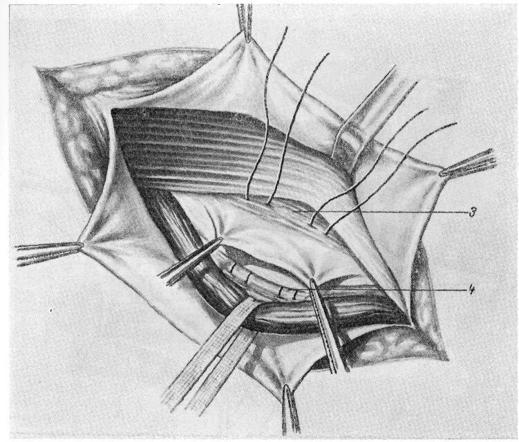 Грыжесечение паховой грыжи. Грыжесечение по Кукуджанову. Паховая грыжа герниопластика.