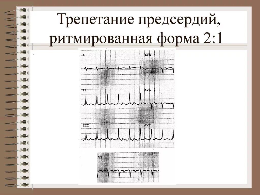 Трепетание предсердий 2 1. Трепетание предсердий 2 к 1 на экг. трепетание предсердий 1 к 1 на экг. трепетание 2 1 на экг. трепетание предсердий неритмированная форма.