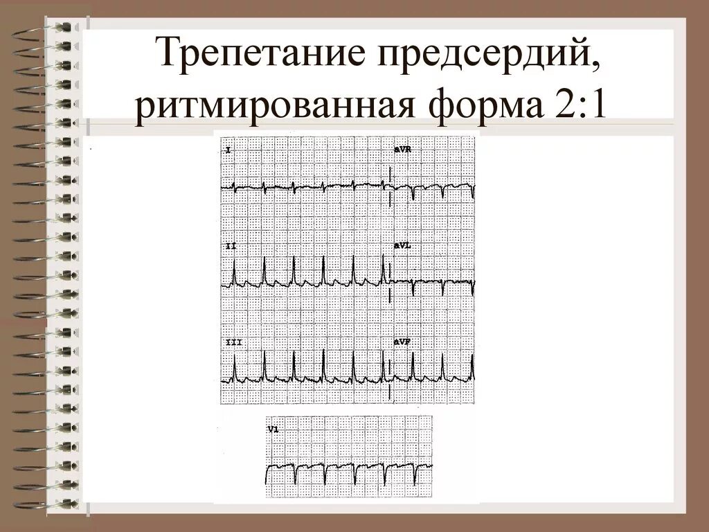 Трепетание предсердий 2 к 1 на ЭКГ. Трепетание предсердий 1 к 1 на ЭКГ. Пароксизм трепетания предсердий 2:1. Правильная форма трепетания предсердий 2 1. Формы трепетания предсердий