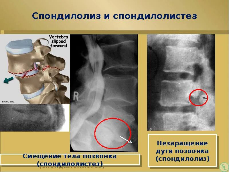 Операция смещение позвоночника. Спондилолиз l4. Спондилолиз l5 рентген. Спондилолистез поясничного отдела рентген. Спондилолиз и спондилолистез.