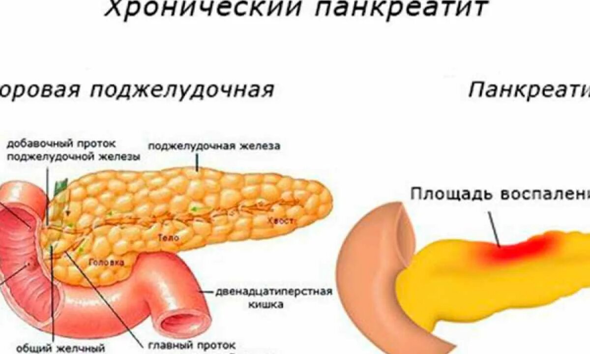 что такое панкреатит поджелудочной. панкреатит и панкреонекроз. признаки больной поджелудочной. болезнь хронический панкреатит поджелудочной железы. поражения поджелудочной железы иллюстрации.