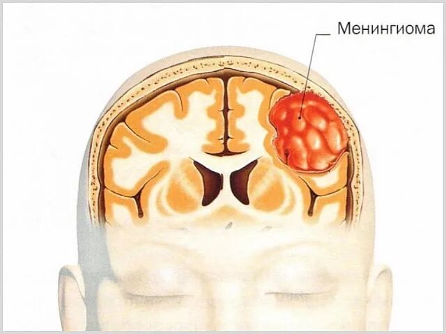 После операции менингиомы головного мозга. Менингиома доброкачественная. Менингиома головного мозга доброкачественная. Злокачественная менингиома.
