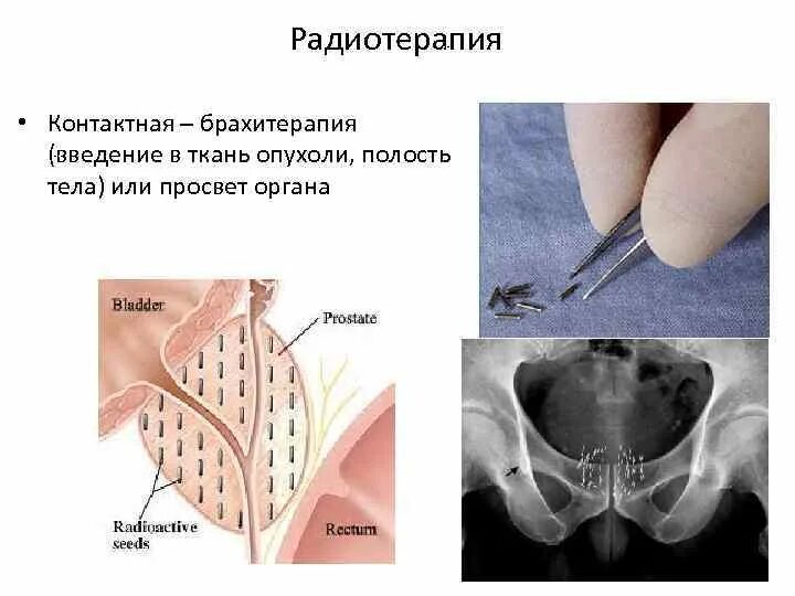 Брахитерапия простаты цена. Внутритканевая брахитерапия. Контактная лучевая терапия брахитерапия это. Брахитерапия внутритканевая интерстициальная. Аппликаторы для брахитерапии.