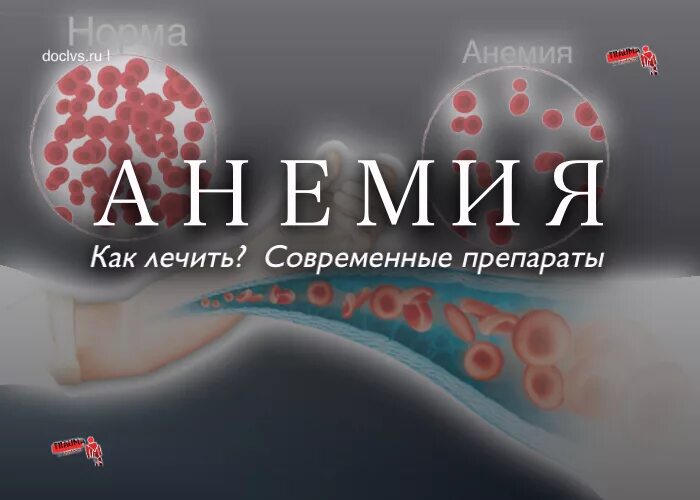 Анемия и вес. Синдромы железодефицитной анемии. Железодефицитная анемия бледность.